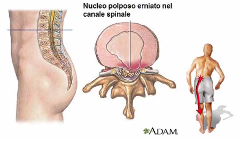 Ernia del disco Lombare