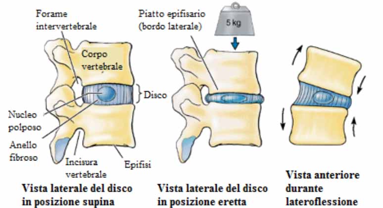 Ernia del disco Lombare